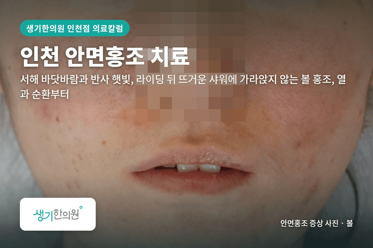 볼 안면홍조 증상 사진과 문구 「인천 안면홍조 치료, 서해 바닷바람과 반사 햇빛, 라이딩 뒤 뜨거운 샤워에 가라앉지 않는 볼 홍조, 열과 순환부터 · 생기한의원 인천점」