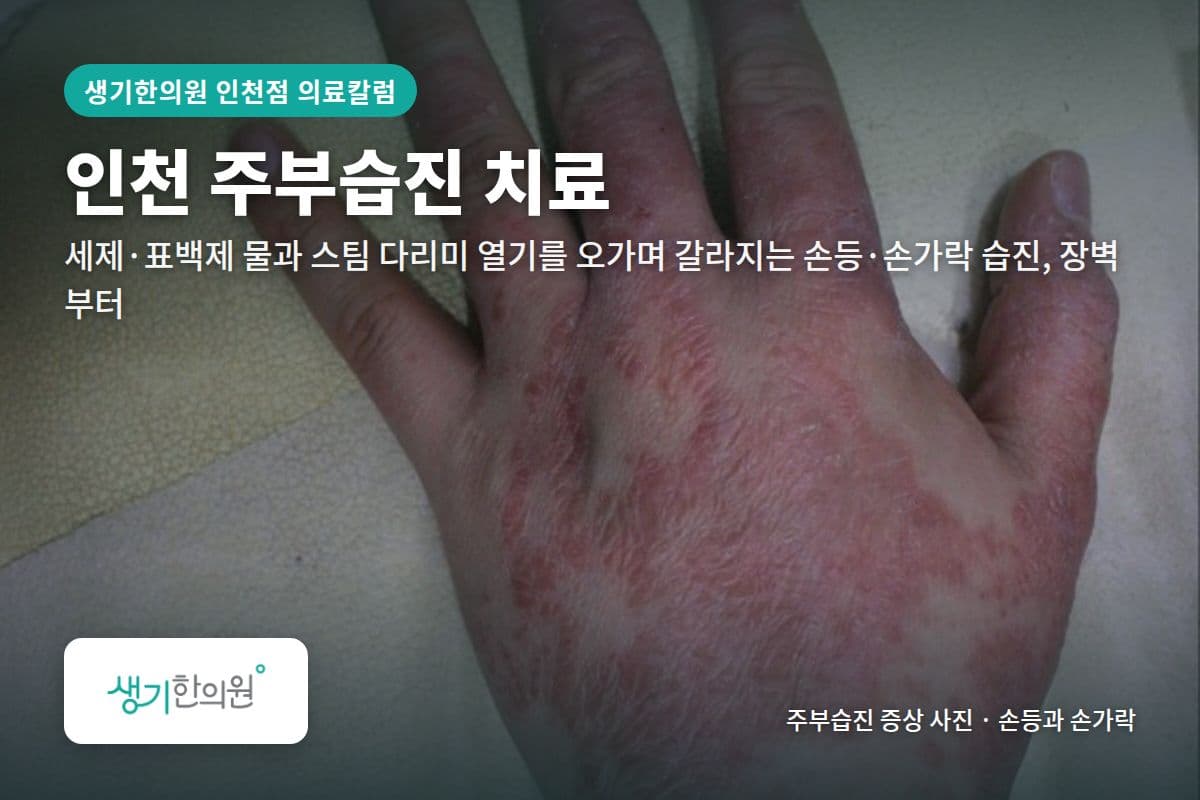 손등과 손가락 주부습진 증상 사진과 문구 「인천 주부습진 치료, 세제·표백제 물과 스팀 다리미 열기를 오가며 갈라지는 손등·손가락 습진, 장벽부터 · 생기한의원 인천점」