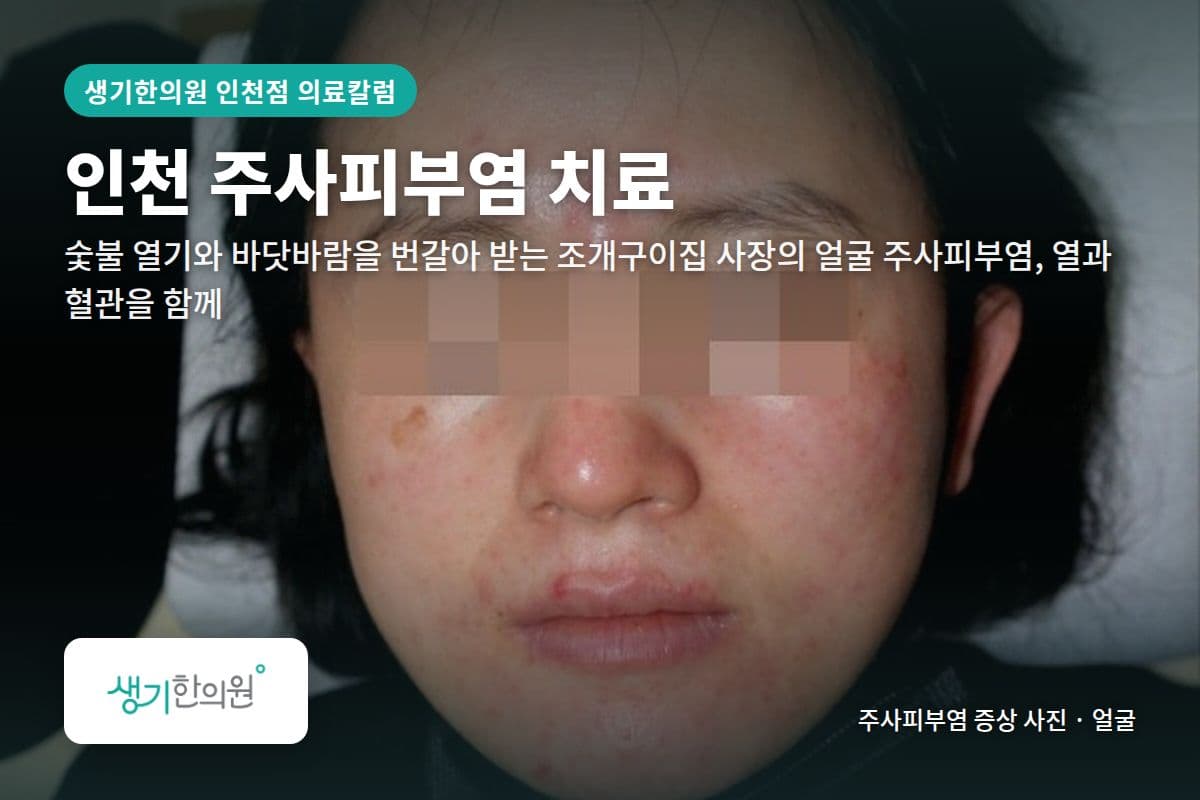 얼굴 주사피부염 증상 사진과 문구 「인천 주사피부염 치료, 숯불 열기와 바닷바람을 번갈아 받는 조개구이집 사장의 얼굴 주사피부염, 열과 혈관을 함께 · 생기한의원 인천점」