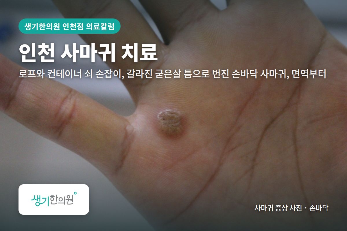 손바닥 사마귀 증상 사진과 문구 「인천 사마귀 치료, 로프와 컨테이너 쇠 손잡이, 갈라진 굳은살 틈으로 번진 손바닥 사마귀, 면역부터 · 생기한의원 인천점」